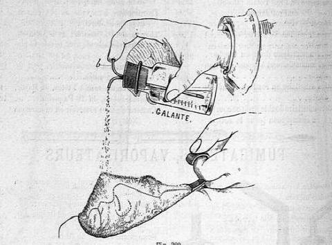 anestesia erogatore goccia  a goccia Larousse Médical Illustré