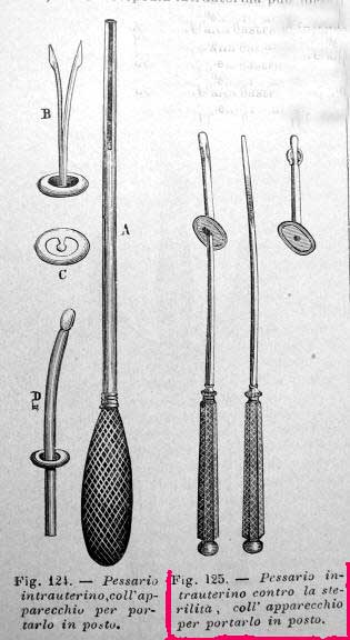 pessario intrauterino 