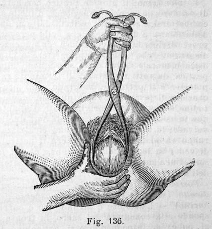 application of forceps 3