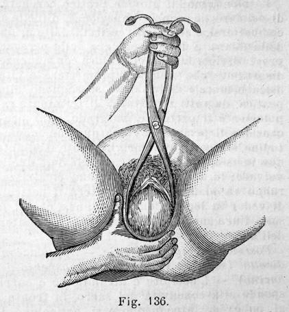 application of forceps 3