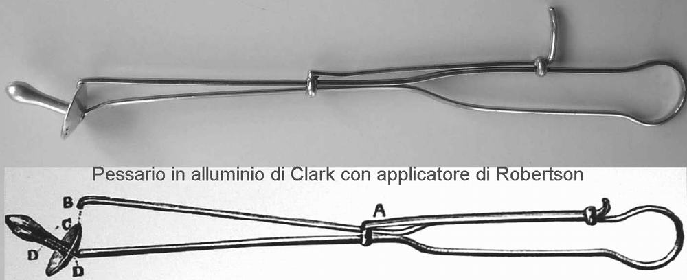 Pessario di Clark con applicatore