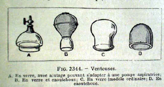 coppette o ventose catalogo